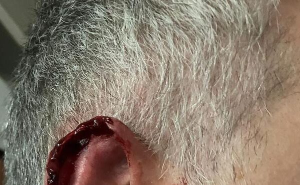 Un ocupa muerde y arranca parte de la oreja a un policía de València
