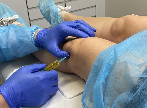 ¿Qué es el plasma rico en plaquetas y qué beneficios tiene para nuestros tejidos?